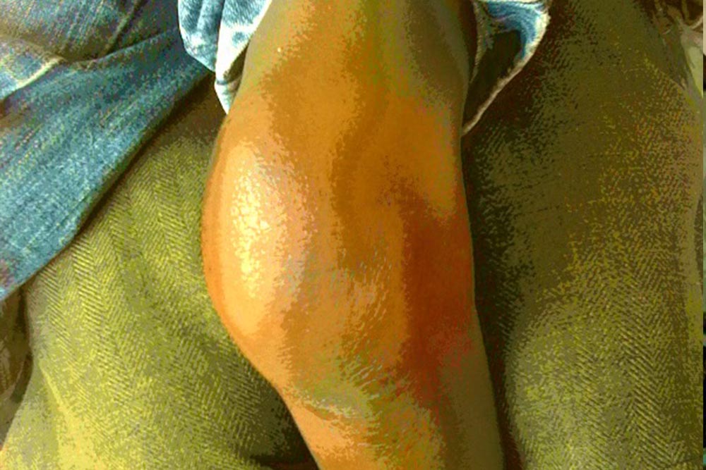 The swollen knee of a child with hemophilia