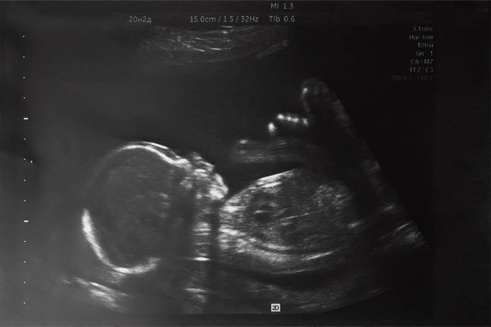 A sonogram ultrasound image of a baby.